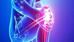 Artrosis: evite la trampa de los analgesicos