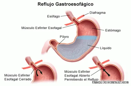 El bicarbonato de sodio nos puede ayudar a regular los niveles del pH del organismo, lo que nos permite aliviar el reflujo ácido. Debemos tomarlo después de comer
